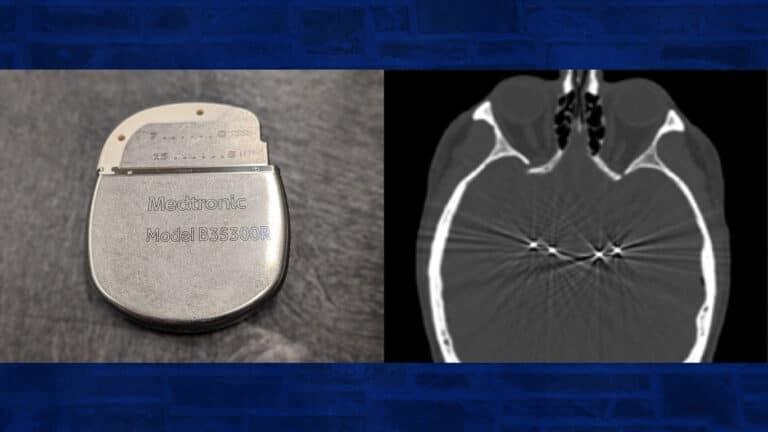 Image of device used for deep brain stimulation