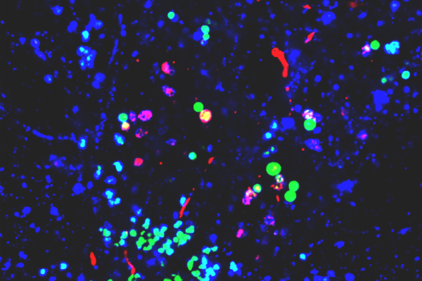 Green plastic nanoparticles co-mingling with red proteins in neuronal lysosome
