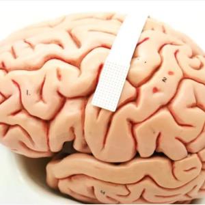 Brain with a small speech decoder implant draped over it
