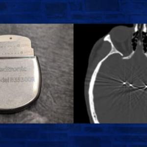 Image of device used for deep brain stimulation